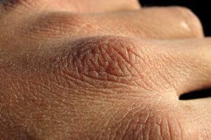 hand-cracks-from-dry-skin
